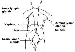 Diagnosis: Hodgkin's lymphoma
